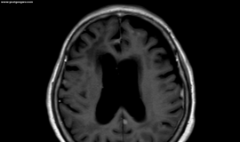 L861Q多发脑转和脑膜转使用佐利替尼联合双倍剂量奥希替尼后效果不佳，求后续方案