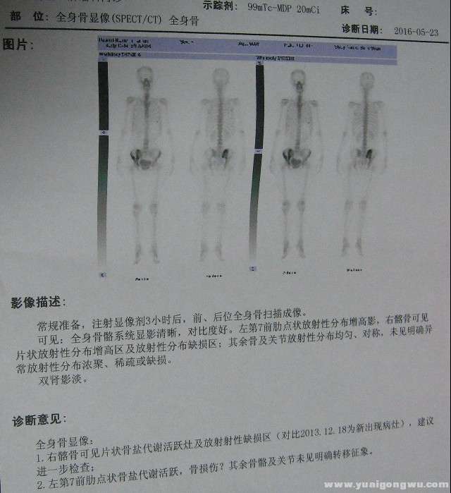 骨扫描.jpg