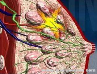乳腺癌示例