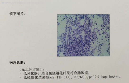 穿刺结果